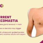 Recurrent Gynecomastia Why It Happens & How to Fix It Permanently