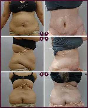 ABDOMINOPLASTY-04-2