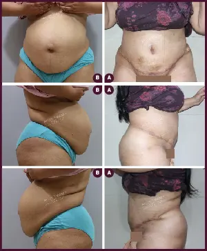 ABDOMINOPLASTY-05-2