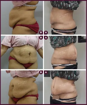 ABDOMINOPLASTY-08-2