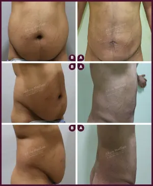 Allure_ABDOMEN_Male_Large_2021-3