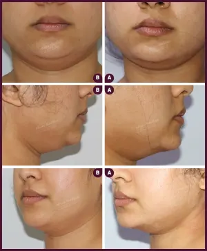 Allure_Liposuction_Female_Chin_2021-2