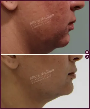 Allure_Liposuction_Female_Chin_2021-3
