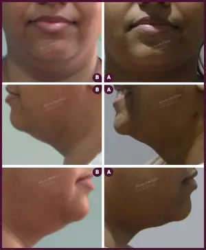 Allure_Liposuction_Female_Chin_2021-4