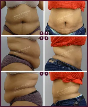 Allure_skin_Tightening_2021-1