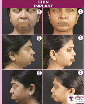 Chin-implant-and-double-chin-liposuctionsurgery-result-and-cost