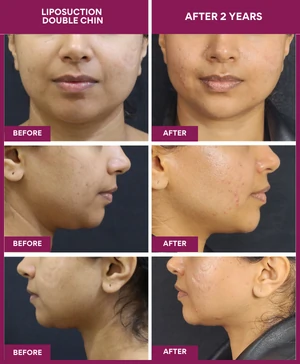 DOUBLE-CHIN-VASER-LIPOSUCTION-SUCTION-SURGERY-RESULT