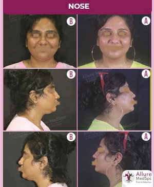 FEMALE-DOUBLE-CHIN-TUMUSCENT-AND-LASER-LIPOSUCTION-SURGERY-RESULT-IMAGES-COST