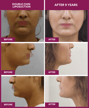 Female-Double-Chin-Liposuction