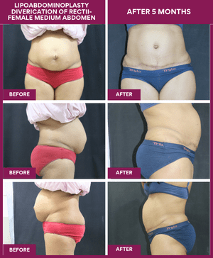LIPOABDOMINOPLASTY-DIVERICATION-OF-RECTII-FEMALE-MEDIUM-ABDOMEN