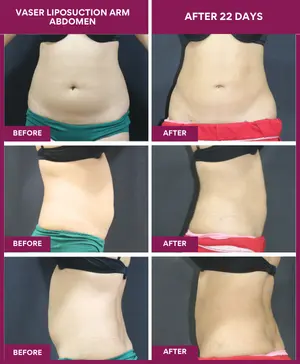 female360-abdomen-vaser-liposuction-surgery-result