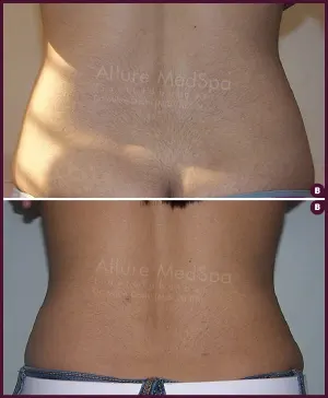 Allure_Liposuction_Back_Fat_Female_2021-1