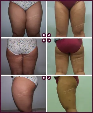 Allure_Liposuction_Thaigh_Large_2021-4