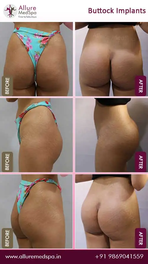 Buttock-Augmentation-Before-After-Results-Mumbai-India