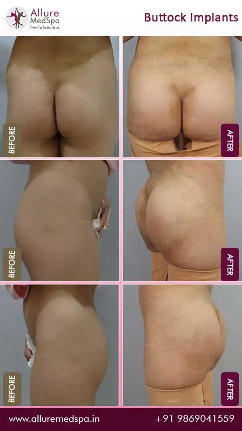 Buttock-Implants-Before-After-Images-Mumbai