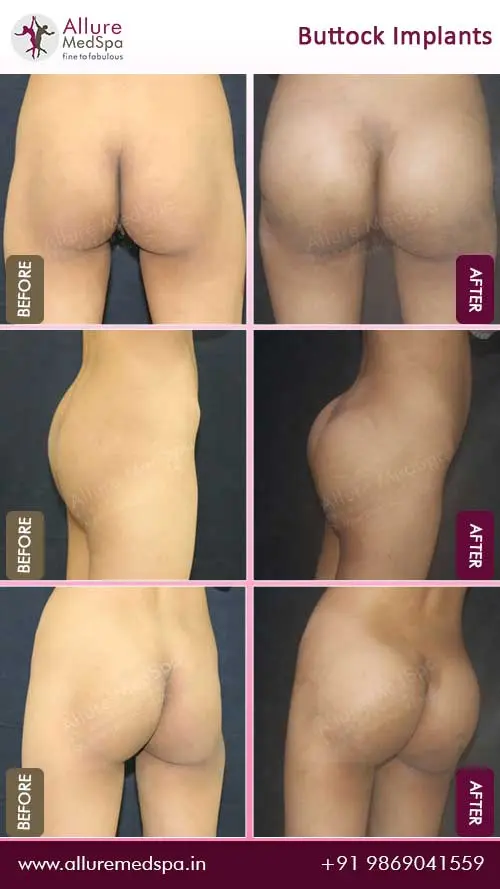 Buttock-Implants-Before-After-Results-Mumbai-India