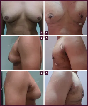 GYNAECOMASTIA_GRADE_03_BF_AFTER-MASSIVE-WEIGHT-LOSS-copy-2