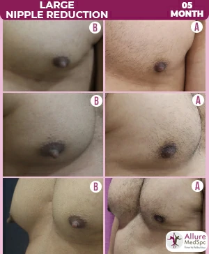 LARGE-NIPPLE-REDUCTION