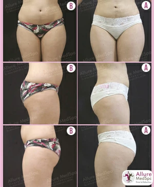 abdomen-lipo