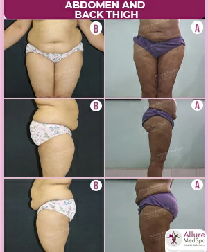 female-large-Abdomen-Back-and-Thigh-vaser-liposuction-result-and-cost