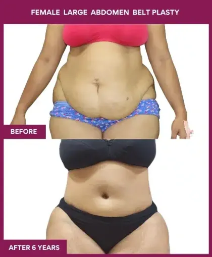 Female BeltPlasty Before After Images in Mumbai, India