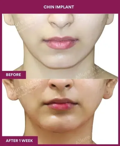 1 Chin Implant in Mumbai, India