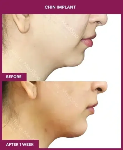 1 Chin Implant in Mumbai, India