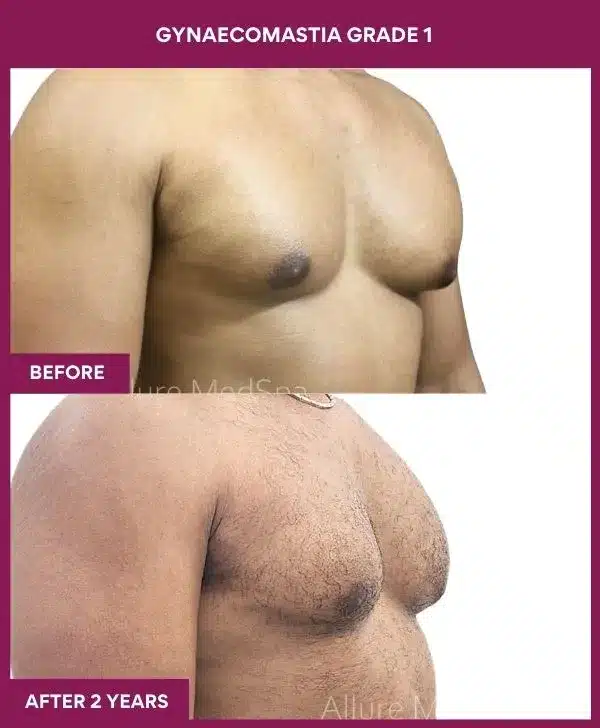 1- GYNAECOMASTIA GRADE 1
