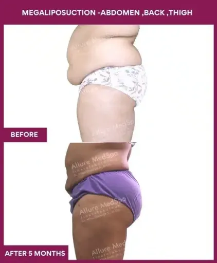 1- MEGALIPOSUCTION -ABDOMEN ,BACK ,THIGH-1