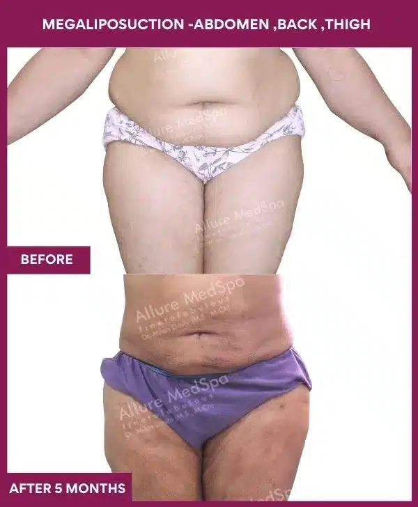 1-MEGALIPOSUCTION -ABDOMEN ,BACK ,THIGH
