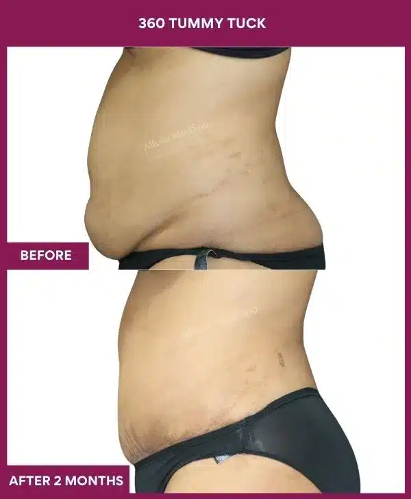 Tummy Tuck Surgery Cost 17 10 360 tummy tuck_30_ (2)