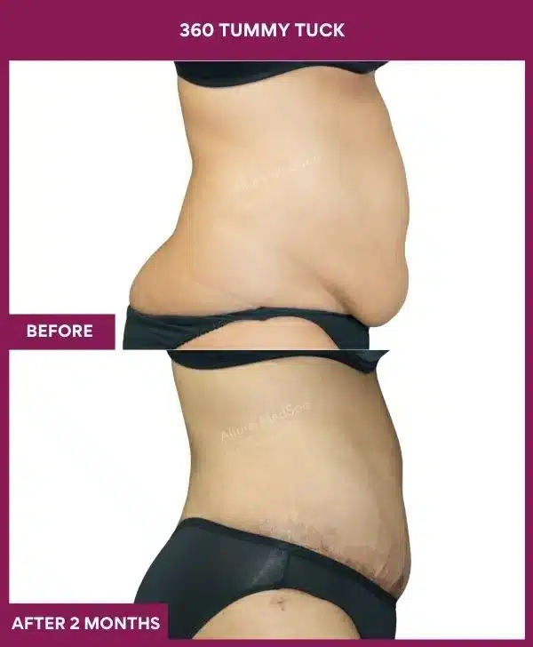 Tummy Tuck Surgery Cost 19 10 360 tummy tuck_30_ (3)