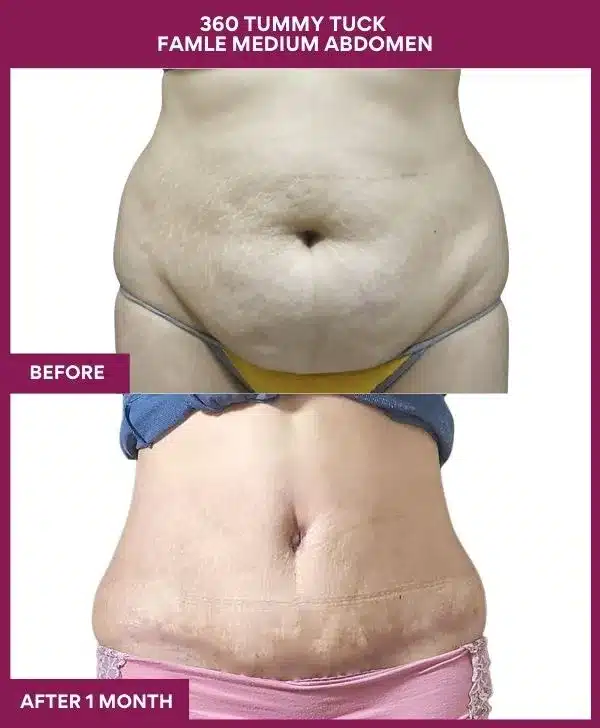 Tummy Tuck Surgery Cost 21 11 360 TUMMY TUCK FAMLE MEDIUM ABDOMEN_33_ (1)
