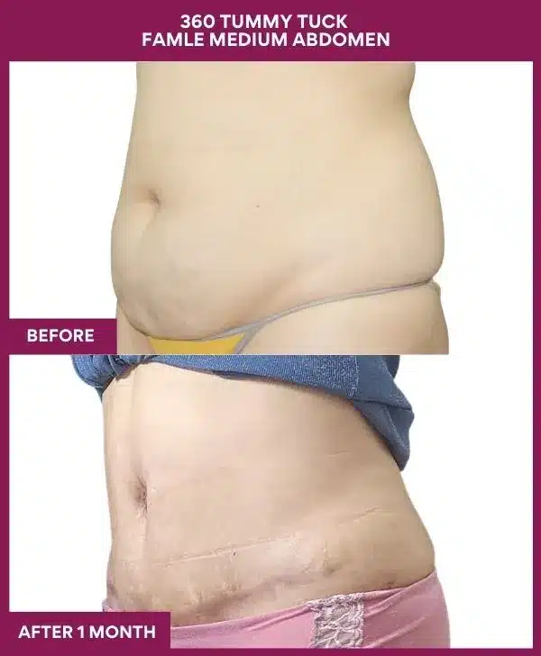 Tummy Tuck Surgery Cost 20 11 360 TUMMY TUCK FAMLE MEDIUM ABDOMEN_33_ (3)