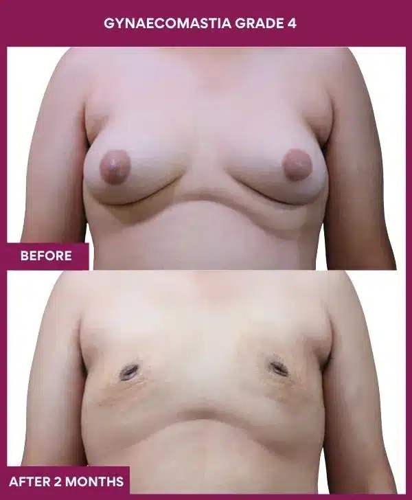 12- GYNAECOMASTIA GRADE 4_