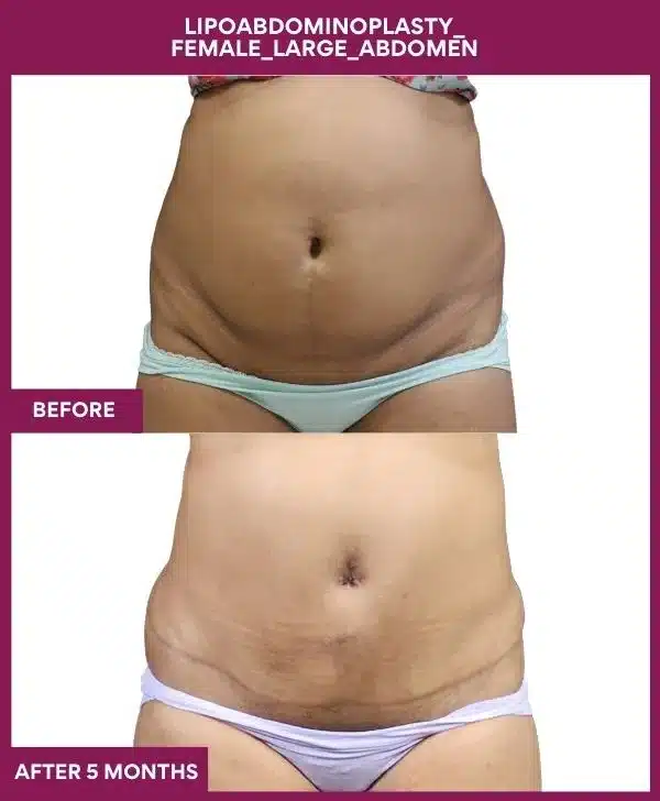 Tummy Tuck Surgery Cost 24 12 Lipoabdominoplasty_ Female_Large_Abdomen_36_ (1)