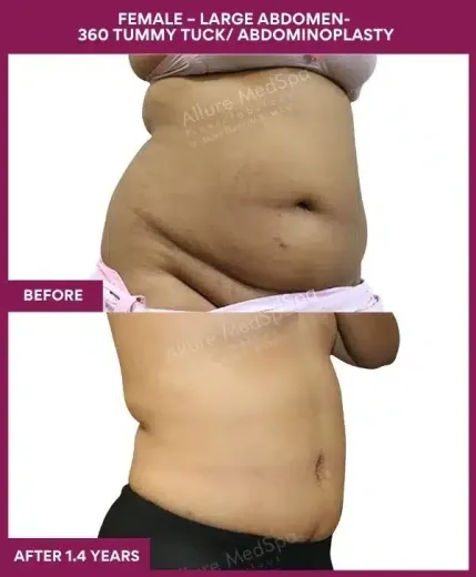 13 FEMALE – LARGE ABDOMEN- 360 TUMMY TUCK_ ABDOMINOPLASTY (2)_37