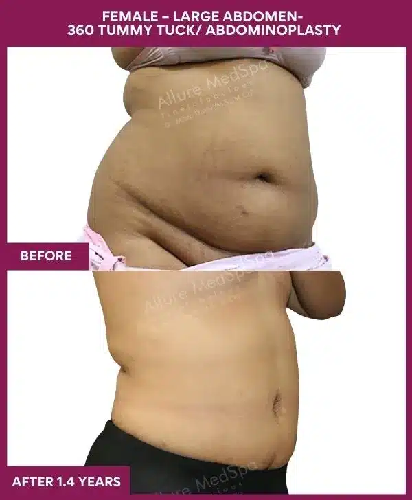 Tummy Tuck Surgery Cost 28 13 FEMALE – LARGE ABDOMEN- 360 TUMMY TUCK_ ABDOMINOPLASTY (2)_37