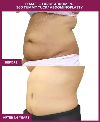 13 FEMALE – LARGE ABDOMEN- 360 TUMMY TUCK_ ABDOMINOPLASTY (3)_38