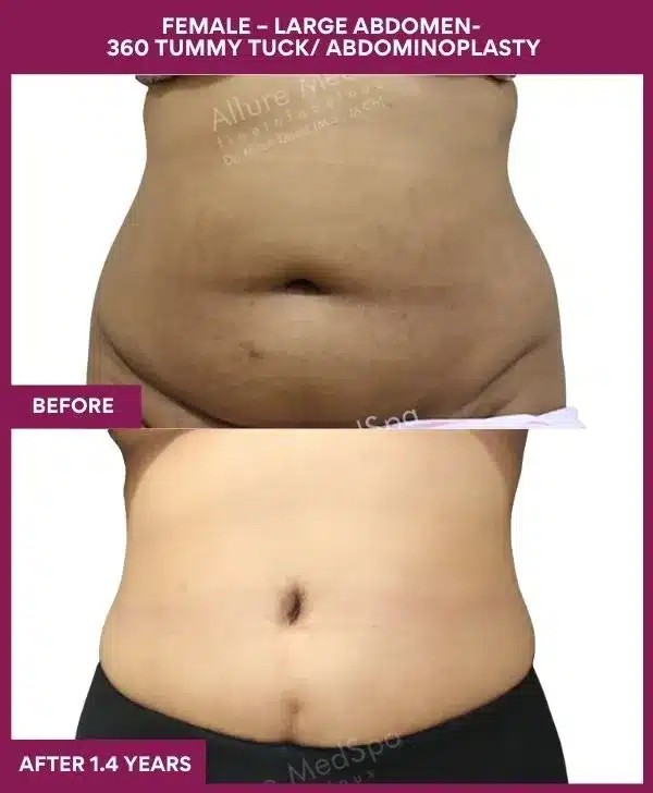 Tummy Tuck Surgery Cost 27 13 FEMALE – LARGE ABDOMEN- 360 TUMMY TUCK_ ABDOMINOPLASTY_39
