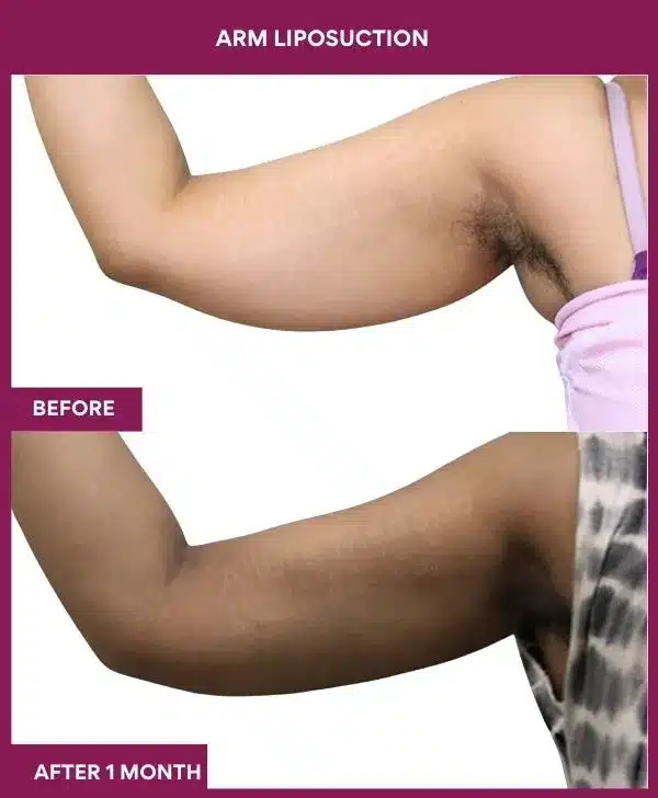 14-arm LIPOSUCTION-