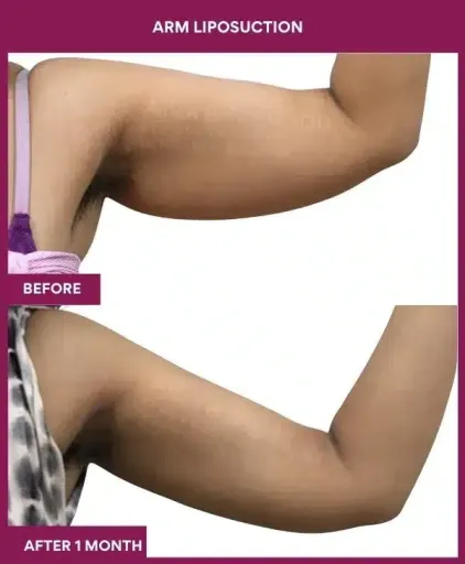14-arm LIPOSUCTION