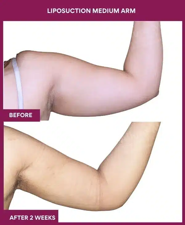17 LIPOSUCTION MEDIUM ARM-