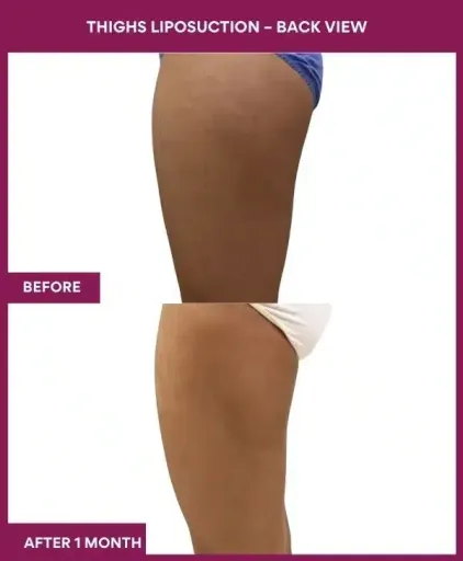 18 Thighs Liposuction – Back View--