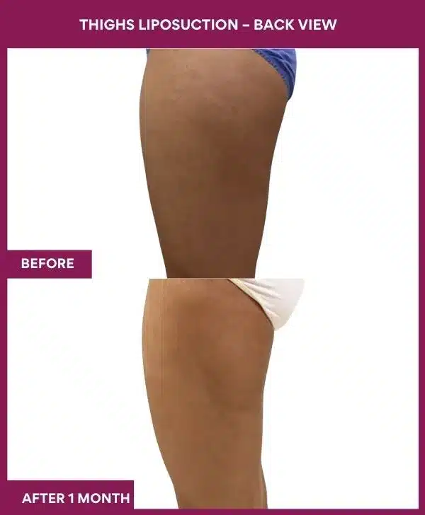 18 Thighs Liposuction – Back View--