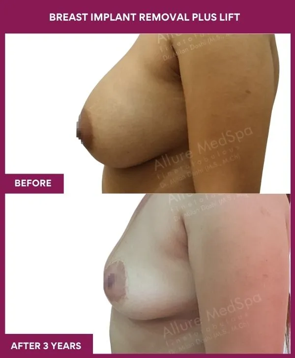 2 Breast Implant Removal Plus Lift (2)_4_