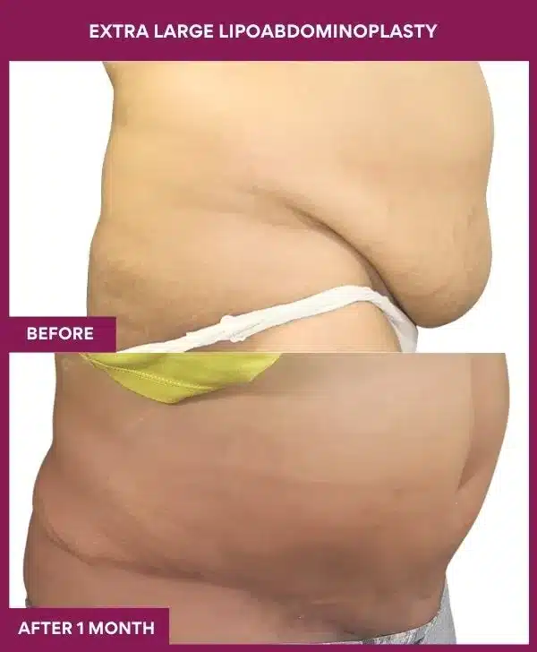 Tummy Tuck Surgery Cost 7 2 EXTRA LARGE LIPOABDOMINOPLASTY_6_ (2)