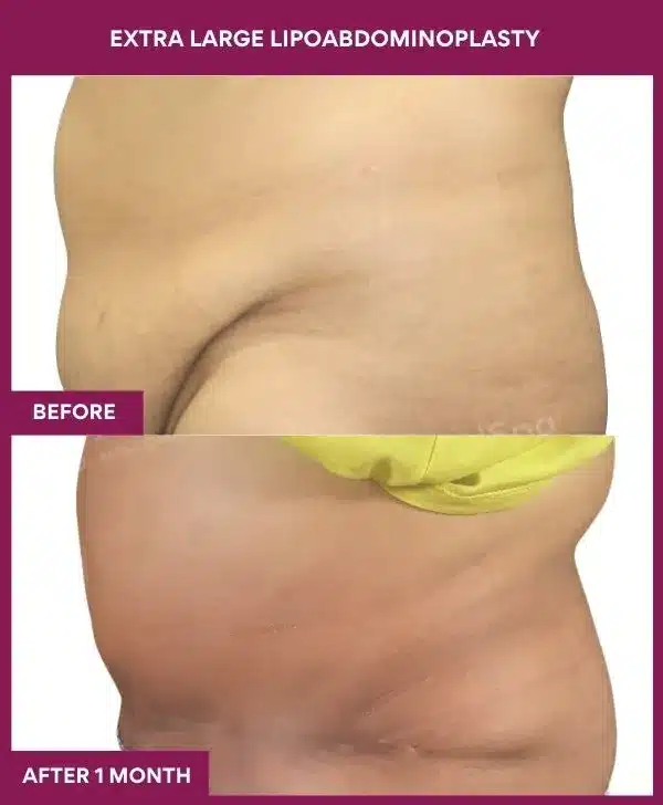 Tummy Tuck Surgery Cost 5 2 EXTRA LARGE LIPOABDOMINOPLASTY_6_ (3)