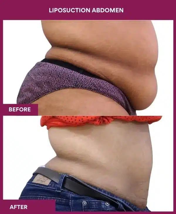 2- liposuction abdomen-