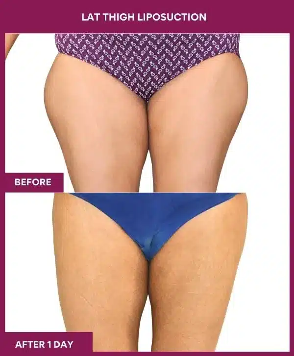 20 LAT THIGH LIPOSUCTION